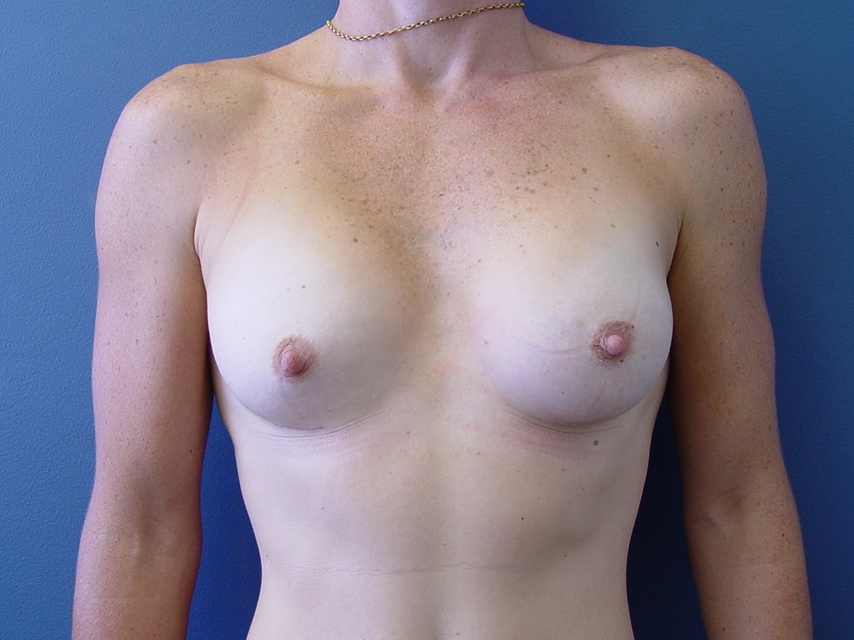 After-Breast_Augmentation