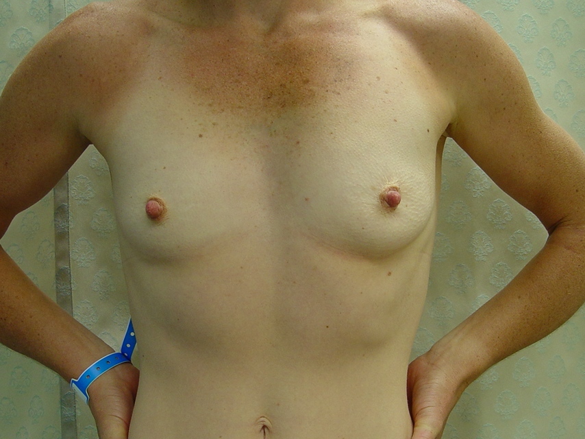 Before-Breast_Augmentation