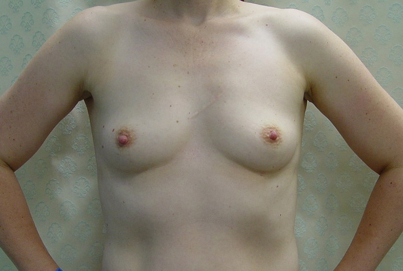 Before-Breast_Augmentation